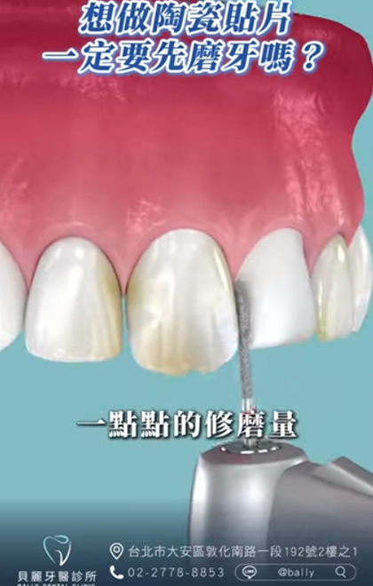 需要輕微修磨才能貼合牙齒