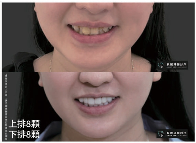 全瓷貼片案例-上排8顆牙齒
